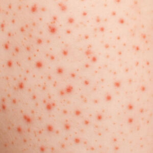 erupciones en piel por dengue